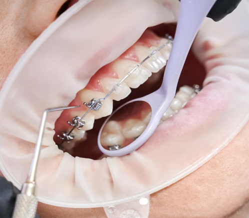 Straighten Your Smile with Palate Expanders: Everything You Need to Know