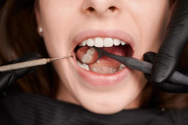 Wisdom Teeth Stitches: What You Need to Know for a Smooth Recovery